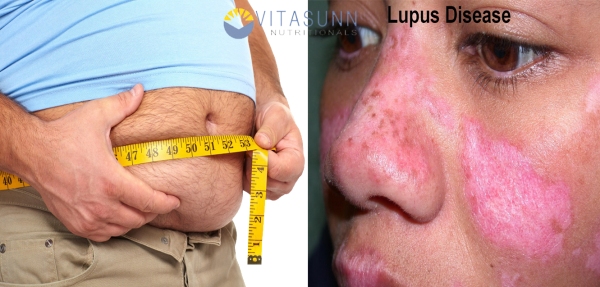 obesity-and-lupus-health-problems